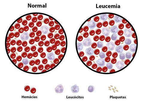o que é leucemia